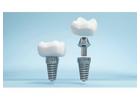 Siiodent Implants: High-Quality Dental Implants Manufacturer