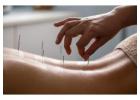 Acupuncture Treatment in Toronto: Discover the Benefits at King Thai Massage Health Care Centre