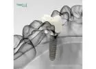 Dental Implant OEM Suppliers In Guatemala | Custom Solutions