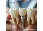 Reliable & Trusted OEM Dental Implant Suppliers In Peru
