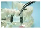 Dental Implants for Wholesalers: Bulk Orders Available