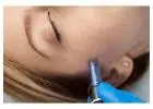 Erbium Laser Skin Resurfacing Clermont