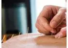 Acupuncture Treatment in Toronto: Simple and Effective Pain Relief