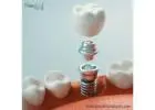 Dental Implant Manufacturers In Honduras for Ritual Provide