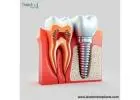 Dentists’ Top Pick: Dental Implant Equipment in Peru