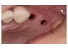 Full Mouth Dental Implants in Mexico with Teeth Savers