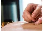 Acupuncture Toronto: Personalized Sessions with Well-Trained Professionals