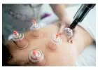 Cupping Therapy Toronto: Relieves Tension And Restores Natural Energy Flow