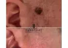 Skin tag removal clinic Goodmayes