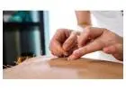 Acupuncture Toronto: Traditional Therapy for Pain Relief and Wellness