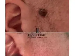 Skin tag removal clinic Goodmayes Skin tag removal clinic Goodmayes