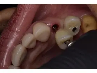 Get Your Perfect Smile by Treating from Dentist in Tijuana