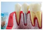 Restore Your Smile with Advanced Dental Implants in Pickering