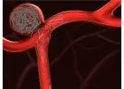 Brain Aneurysm Repair Surgery for Safe & Effective Treatment