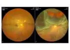 Best Retina Surgeon for Advanced Eye Care Treatment