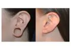 Fix Stretched Earlobes in Delhi – Book Your Consultation Today