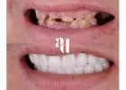 All-On-4 Dental Implants - Avira Dental