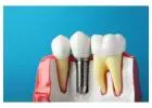 Navigating Dental Implants in Chennai: A Patient’s Guide
