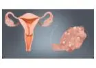 Best PCOS Doctor in Dubai - Women Health