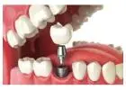 Dental Implants Oxenford – Restore Your Smile with Confidence