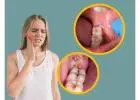 Professional Wisdom Teeth Care for a Healthier Smile