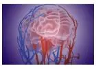 Stenting Renal Artery Treatment for Better Blood Flow