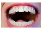 How Crowns Teeth Can Improve Your Smile and Oral Health