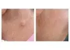 Cyst Removal Harley Street – Professional Dermatology Care in London
