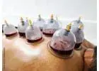 Cupping Therapy NYC | Expert Cupping Services in New York City