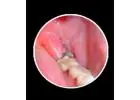 Looking for the Best Wisdom Teeth Removal Services for Comfortable Dental Care?